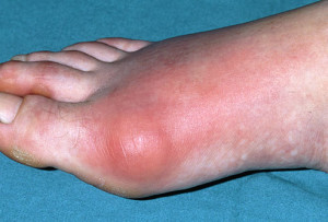 Gout Arthritis