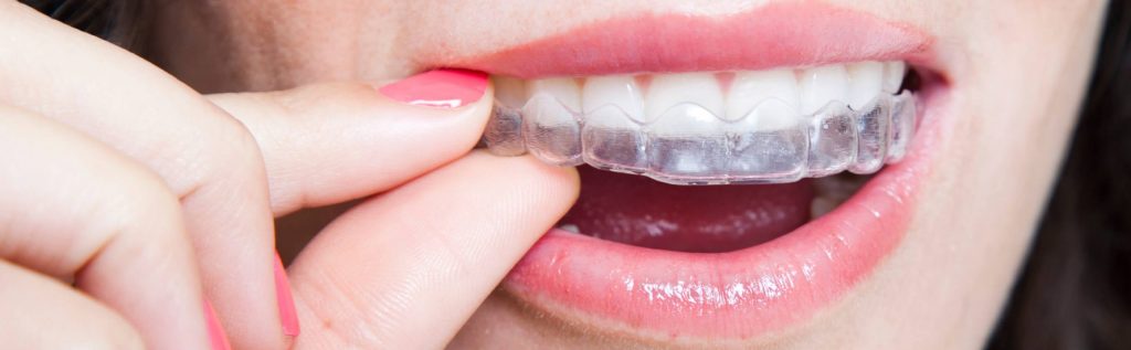 Invisible Braces Buying Guide